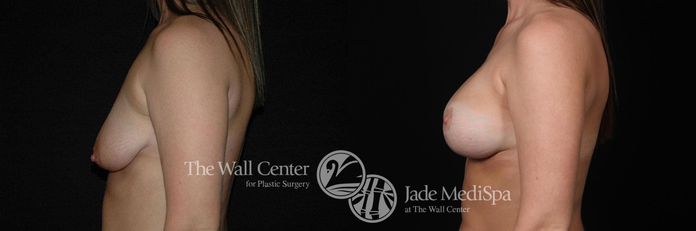 Before & After Breast Augmentation with Lift Case 256 View #3 View in Shreveport, LA