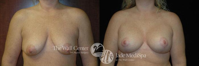 Before & After Breast Augmentation with Lift Case 257 View #1 View in Shreveport, LA