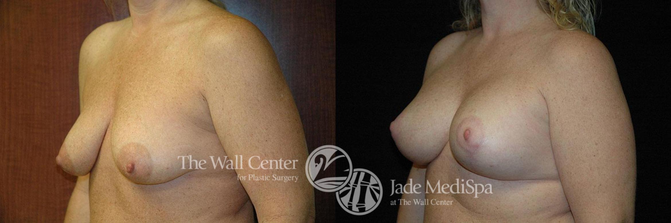 Before & After Breast Augmentation with Lift Case 257 View #2 View in Shreveport, LA