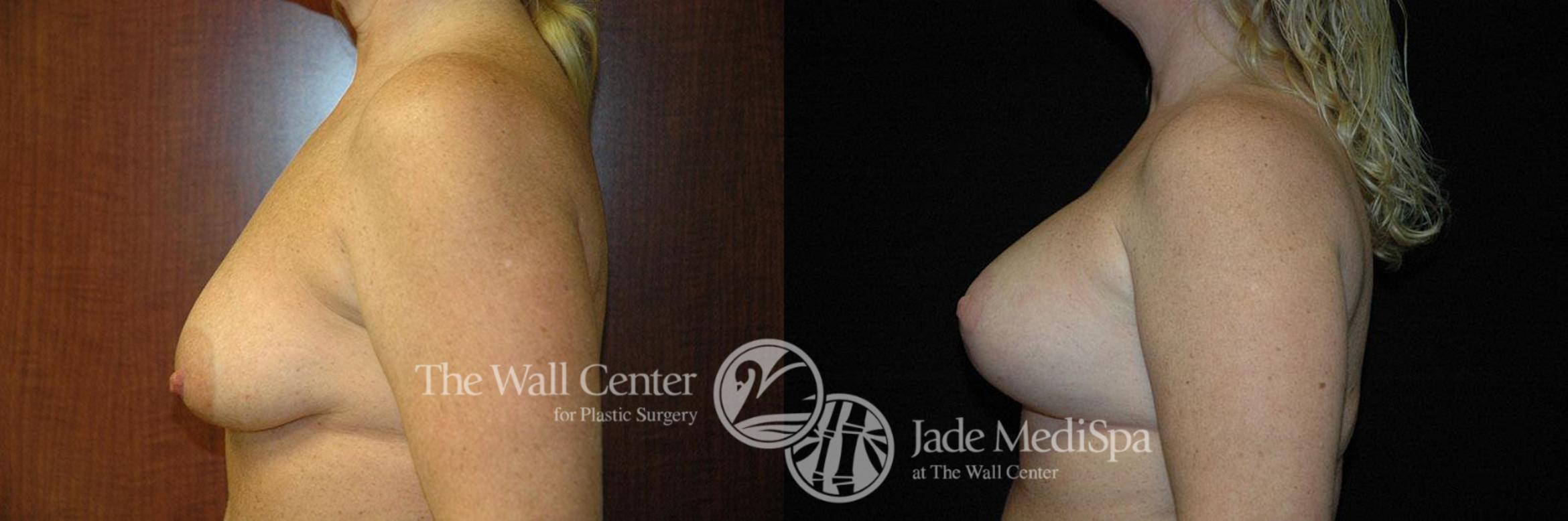 Before & After Breast Augmentation with Lift Case 257 View #3 View in Shreveport, LA