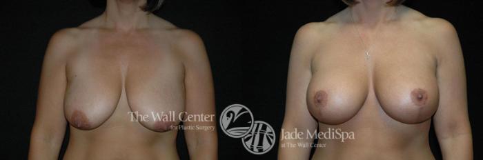 Before & After Breast Augmentation with Lift Case 259 View #1 View in Shreveport, LA