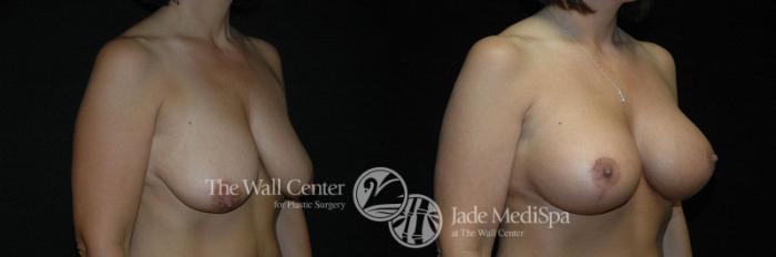 Before & After Breast Augmentation with Lift Case 259 View #2 View in Shreveport, LA