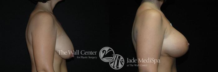 Before & After Breast Augmentation with Lift Case 259 View #3 View in Shreveport, LA