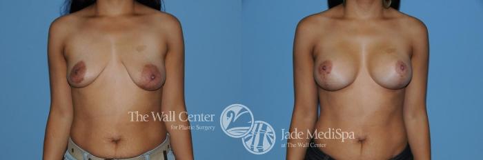 Before & After Breast Augmentation with Lift Case 280 View #1 View in Shreveport, LA