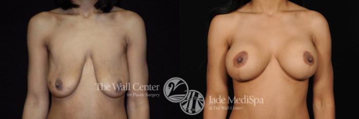 Before & After Breast Augmentation with Lift Case 286 View #1 View in Shreveport, LA