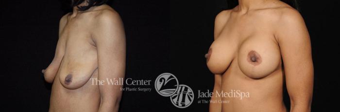 Before & After Breast Augmentation with Lift Case 286 View #2 View in Shreveport, LA
