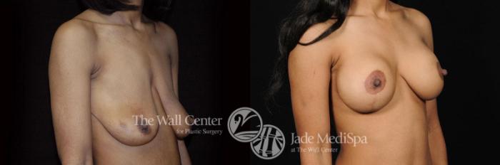 Before & After Breast Augmentation with Lift Case 286 View #3 View in Shreveport, LA