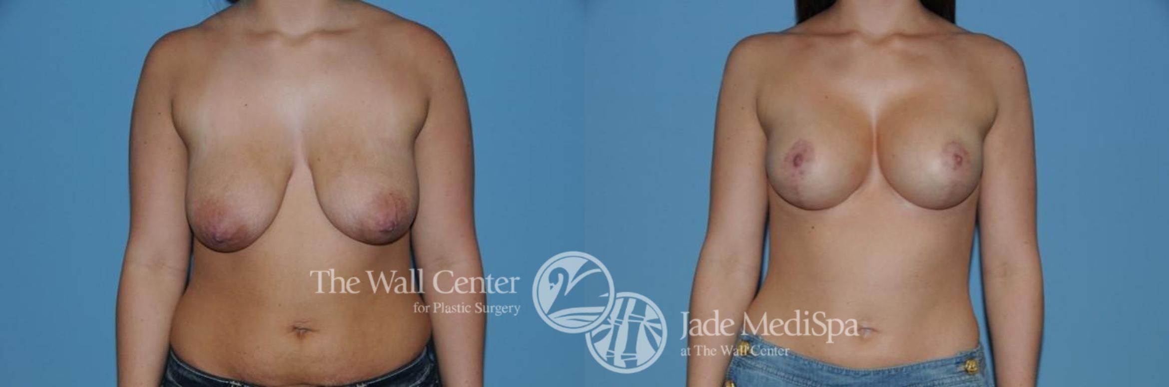 Before & After Breast Augmentation with Lift Case 289 View #1 View in Shreveport, LA