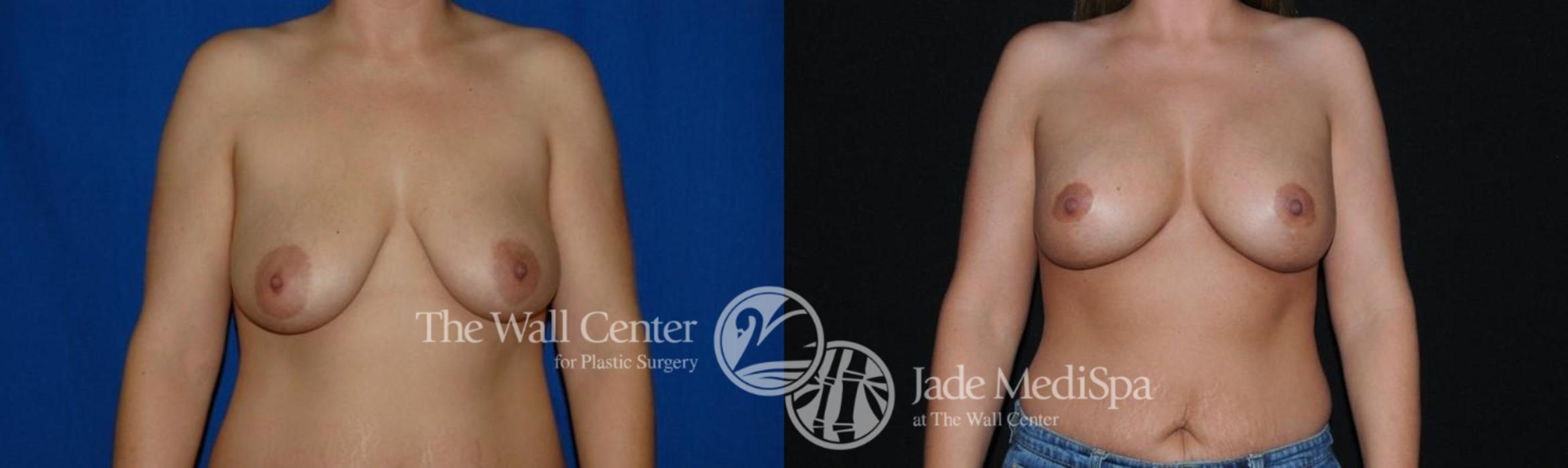 Before & After Breast Augmentation with Lift Case 291 View #1 View in Shreveport, LA