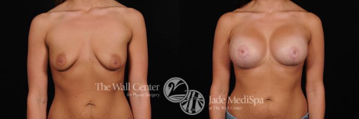 Before & After Breast Augmentation with Lift Case 317 View #1 View in Shreveport, LA