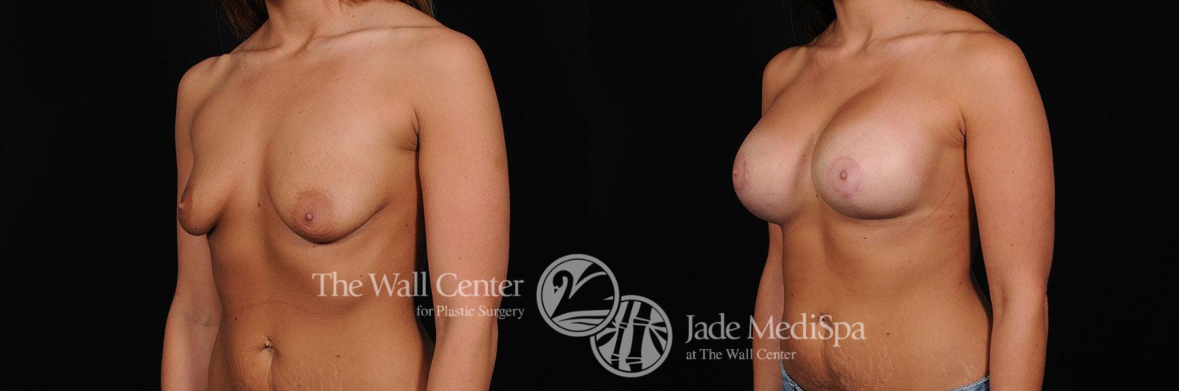 Before & After Breast Augmentation with Lift Case 317 View #2 View in Shreveport, LA