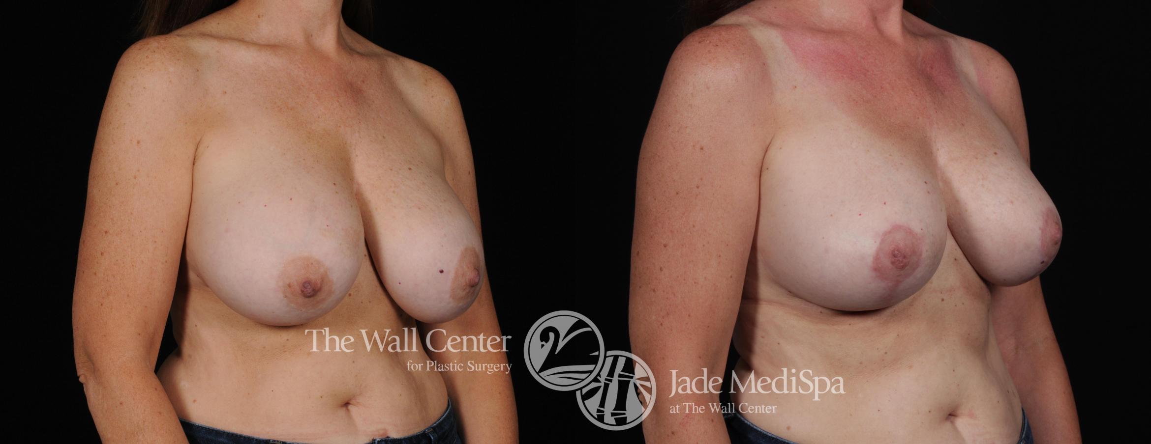 Before & After Breast Reduction Case 446 View #2 View in Shreveport, LA