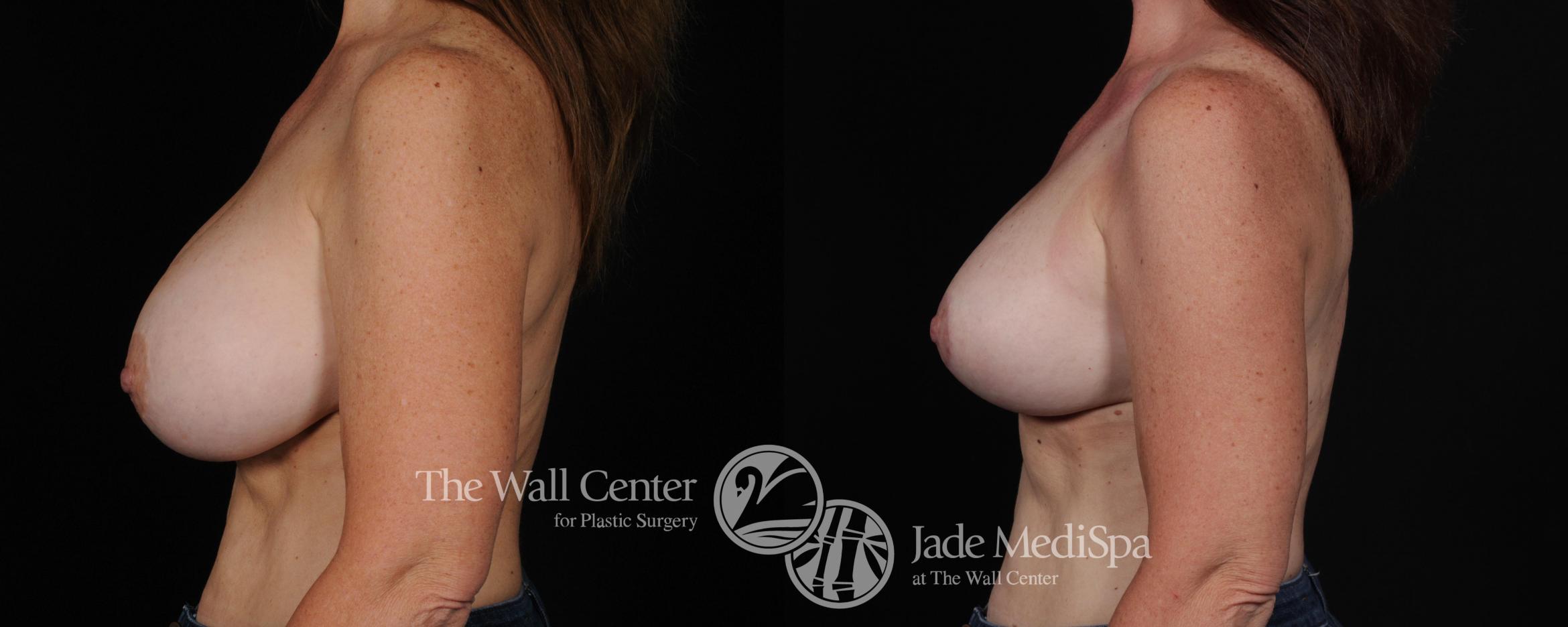 Before & After Breast Augmentation with Lift Case 446 View #3 View in Shreveport, LA