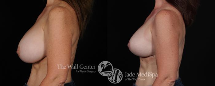 Before & After Breast Lift Case 446 View #3 View in Shreveport, LA