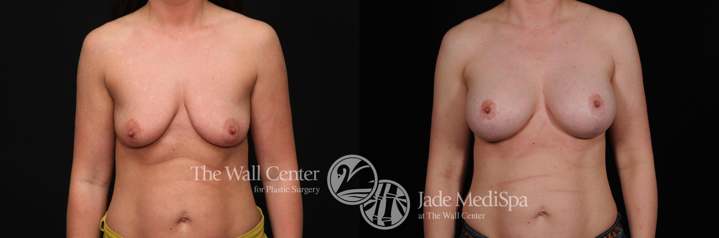 Before & After Breast Augmentation with Lift Case 456 View #1 View in Shreveport, LA