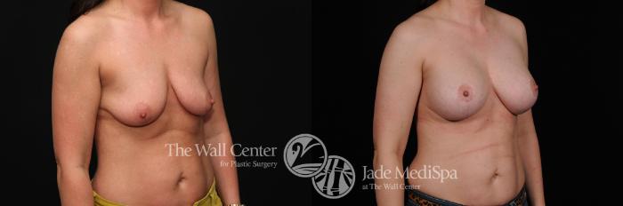 Before & After Breast Augmentation with Lift Case 456 View #2 View in Shreveport, LA
