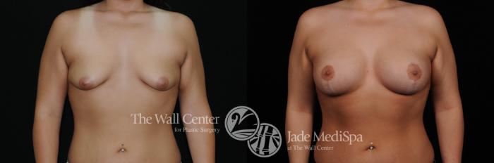 Before & After Breast Augmentation with Lift Case 461 View #1 View in Shreveport, LA