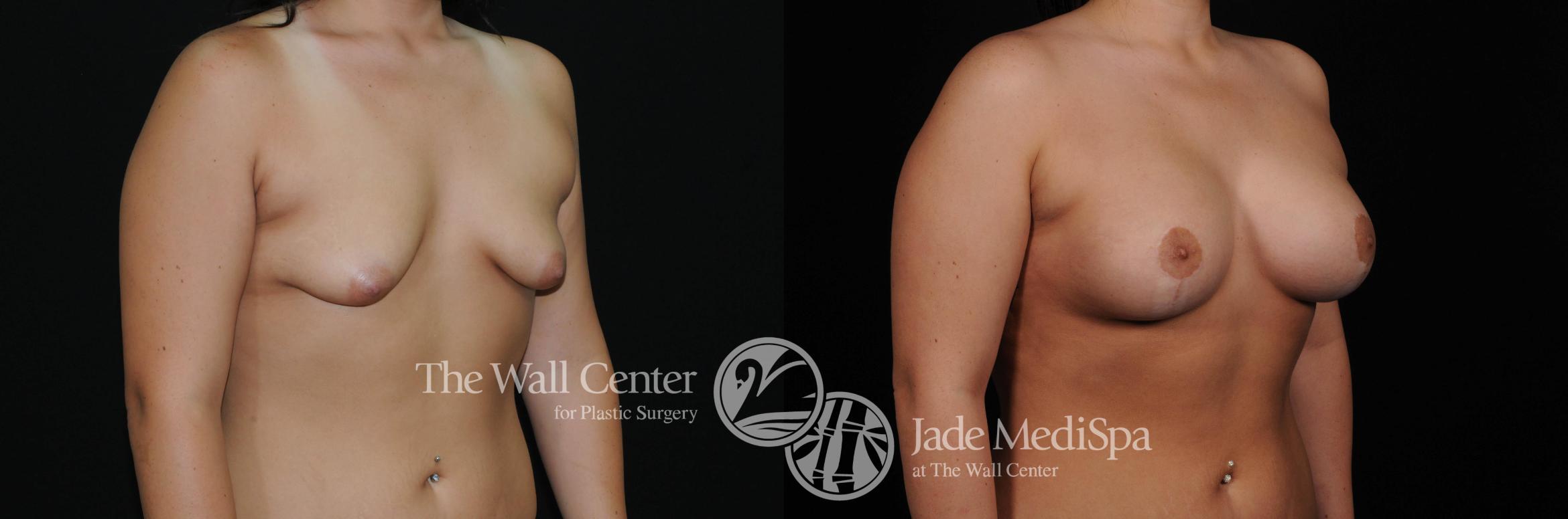 Before & After Breast Augmentation with Lift Case 461 View #2 View in Shreveport, LA