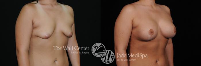 Before & After Breast Augmentation with Lift Case 461 View #2 View in Shreveport, LA