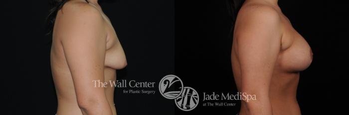 Before & After Breast Augmentation with Lift Case 461 View #3 View in Shreveport, LA