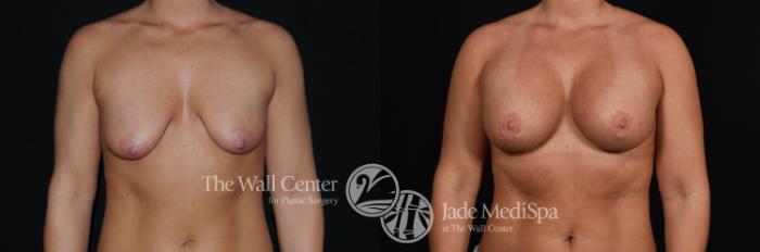Before & After Breast Augmentation with Lift Case 476 View #1 View in Shreveport, LA