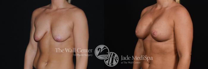 Before & After Breast Augmentation with Lift Case 476 View #2 View in Shreveport, LA