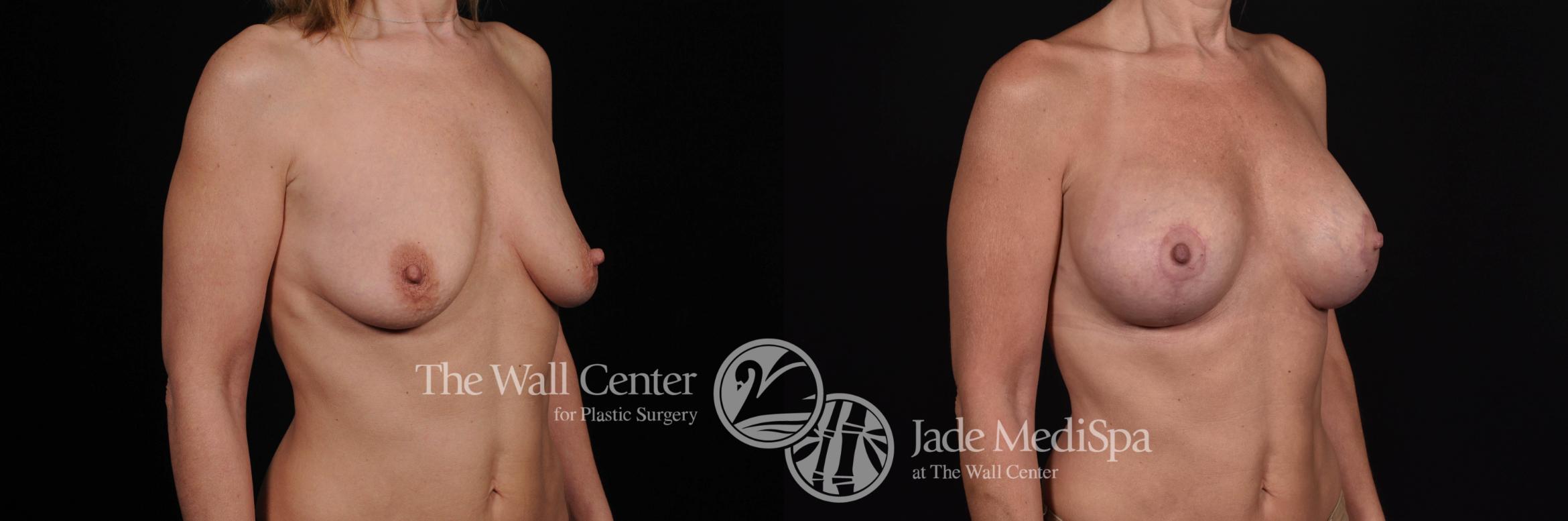 Before & After Breast Augmentation with Lift Case 481 View #2 View in Shreveport, LA
