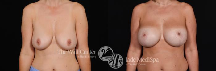 Before & After Breast Augmentation with Lift Case 482 View #1 View in Shreveport, LA