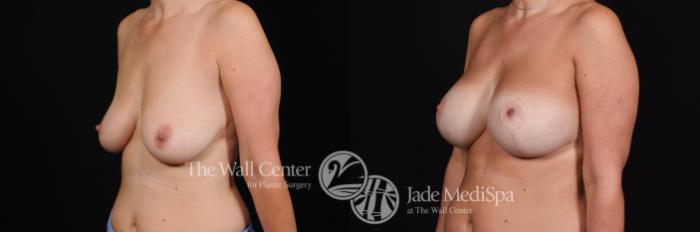 Before & After Breast Augmentation with Lift Case 482 View #2 View in Shreveport, LA