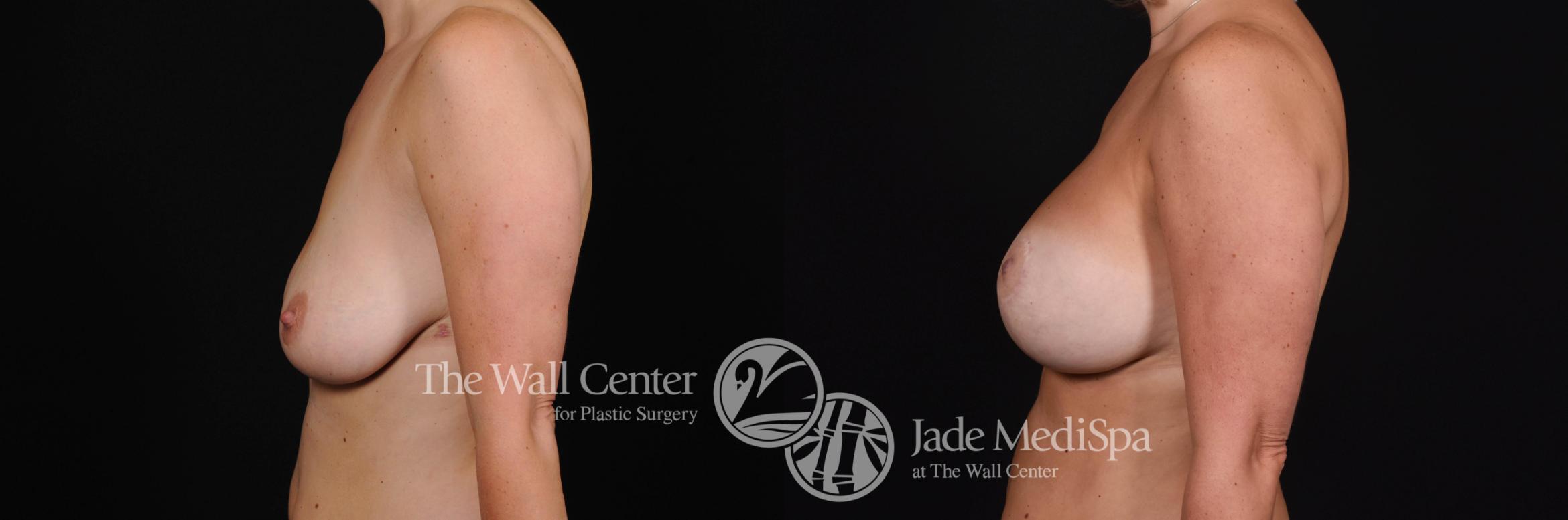 Before & After Breast Augmentation with Lift Case 482 View #3 View in Shreveport, LA