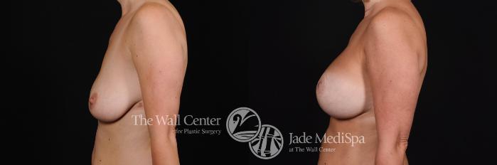 Before & After Breast Augmentation with Lift Case 482 View #3 View in Shreveport, LA