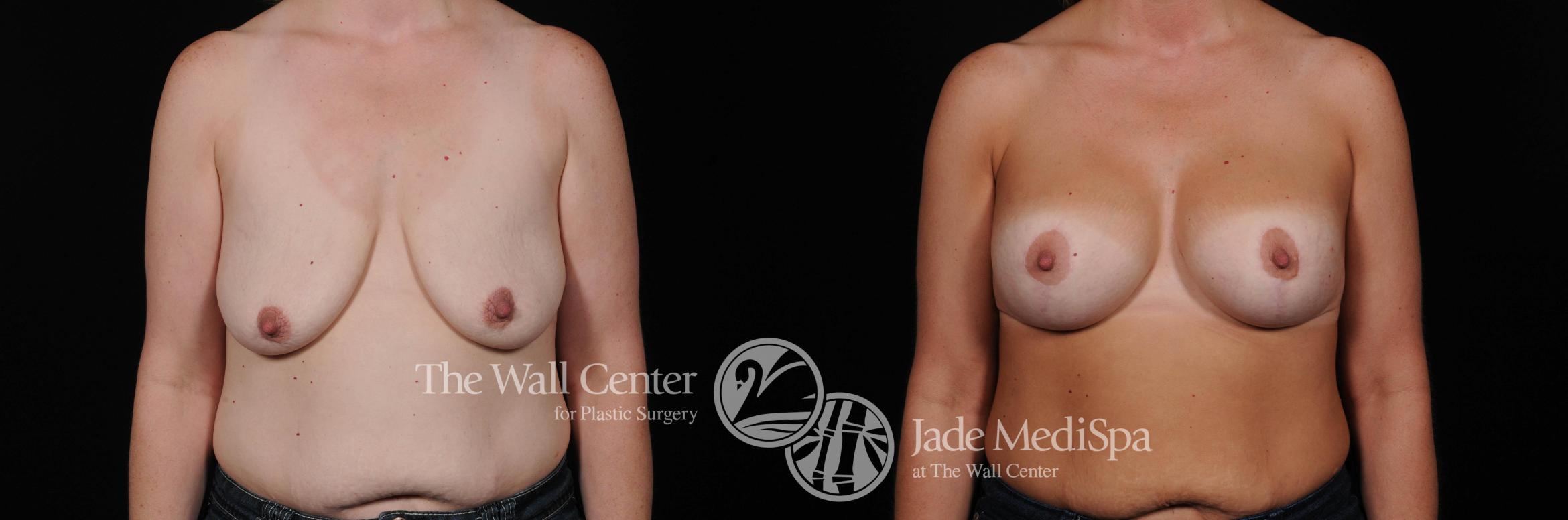 Before & After Breast Augmentation with Lift Case 483 View #1 View in Shreveport, LA