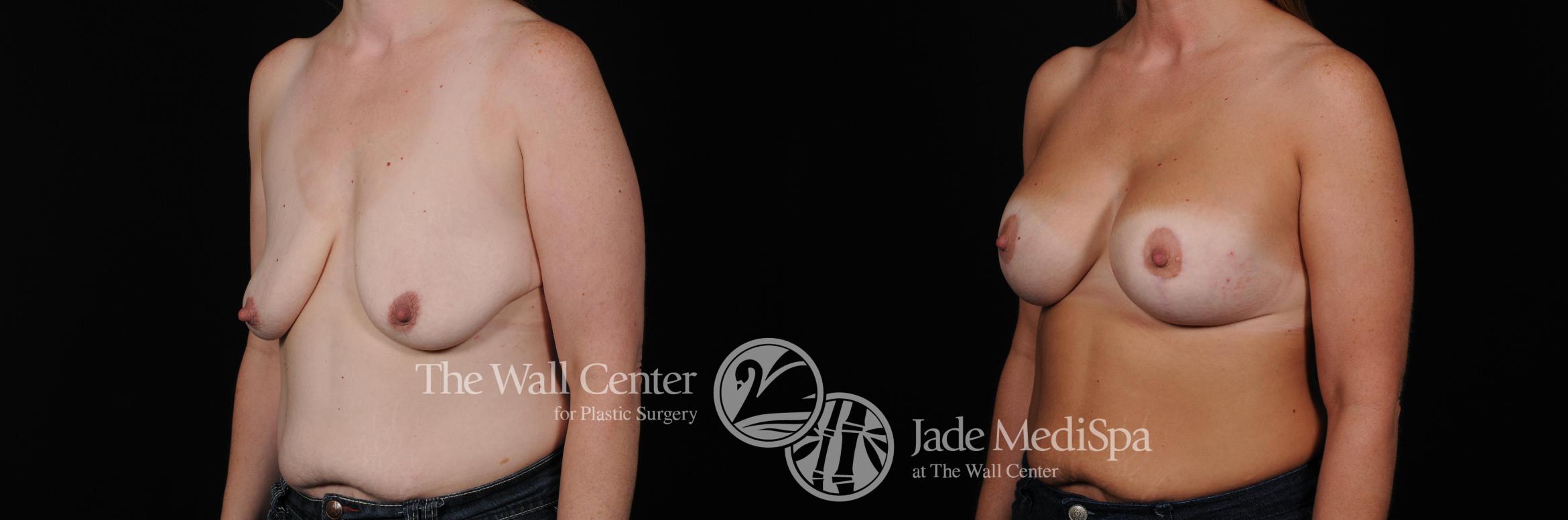 Before & After Breast Augmentation with Lift Case 483 View #2 View in Shreveport, LA
