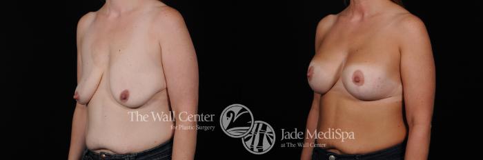 Before & After Breast Augmentation with Lift Case 483 View #2 View in Shreveport, LA
