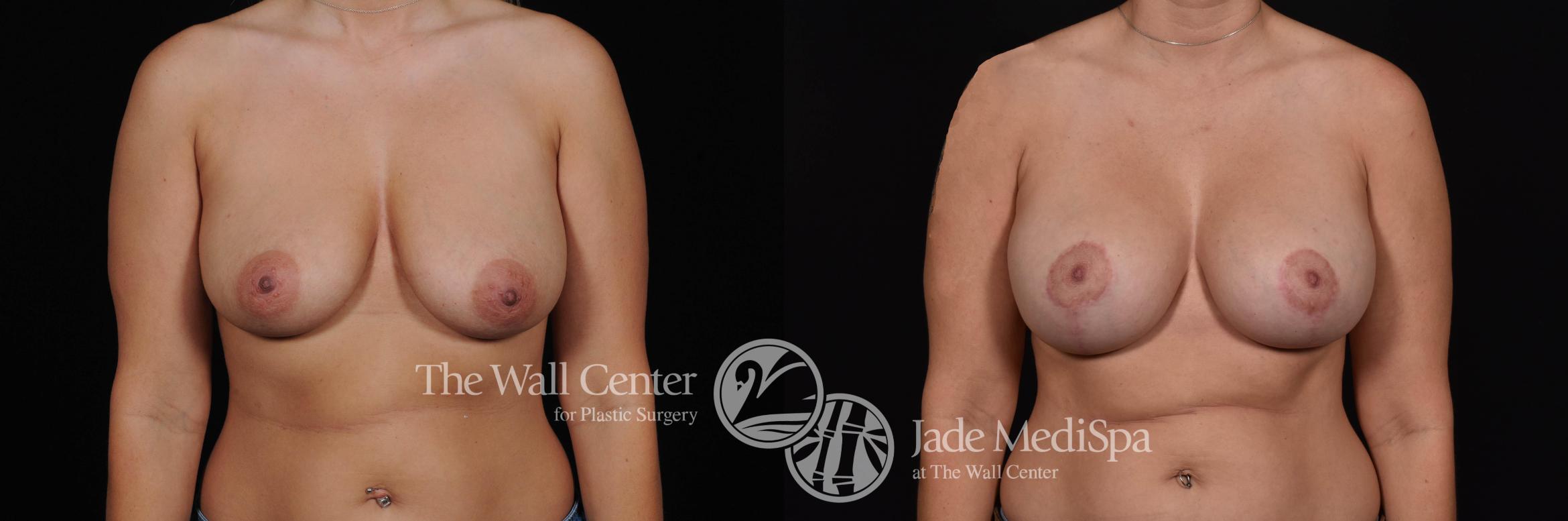 Before & After Breast Augmentation with Lift Case 500 View #1 View in Shreveport, LA