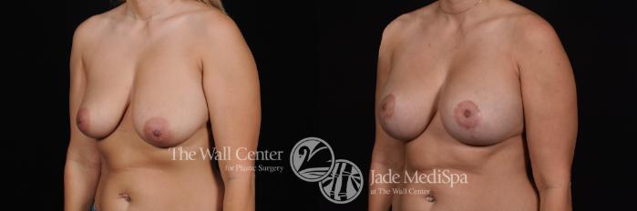 Before & After Breast Augmentation with Lift Case 500 View #2 View in Shreveport, LA