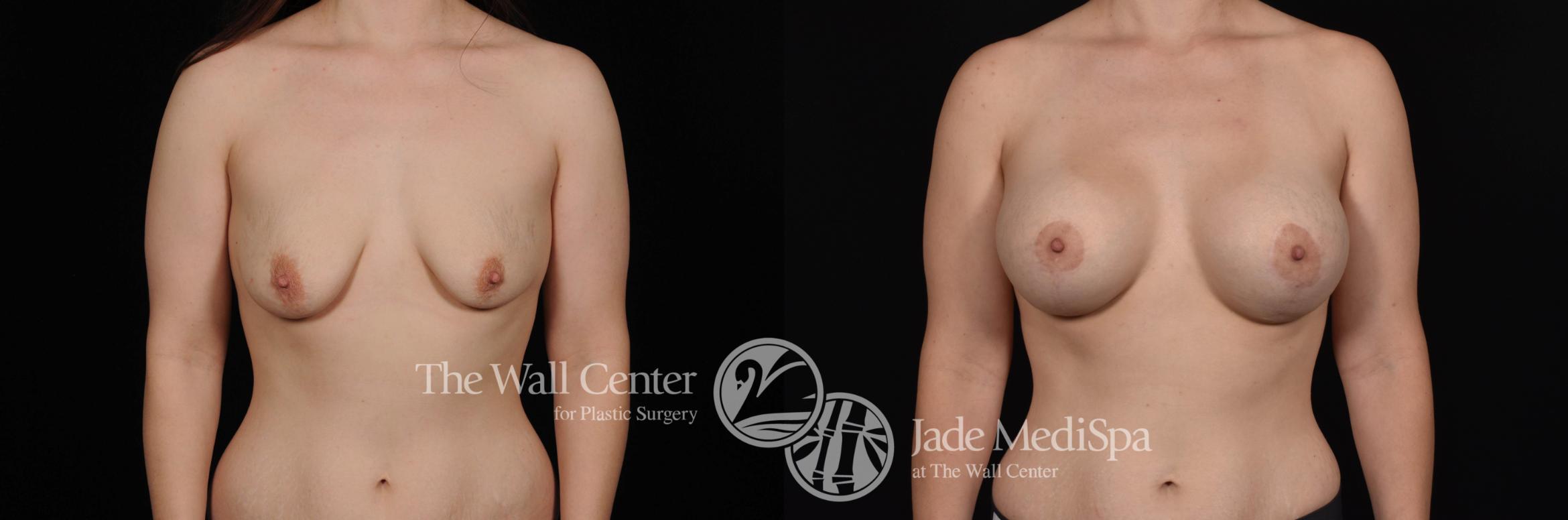 Before & After Breast Augmentation with Lift Case 551 View #1 View in Shreveport, LA