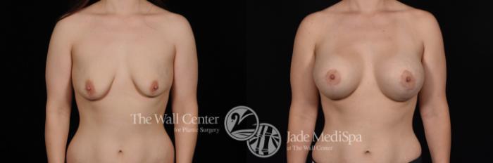 Before & After Breast Augmentation with Lift Case 551 View #1 View in Shreveport, LA