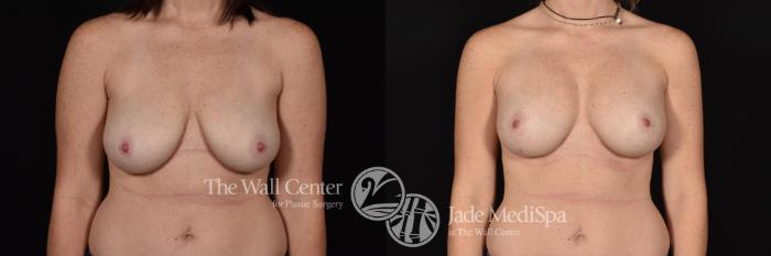 Before & After Breast Augmentation with Lift Case 584 View #1 View in Shreveport, LA