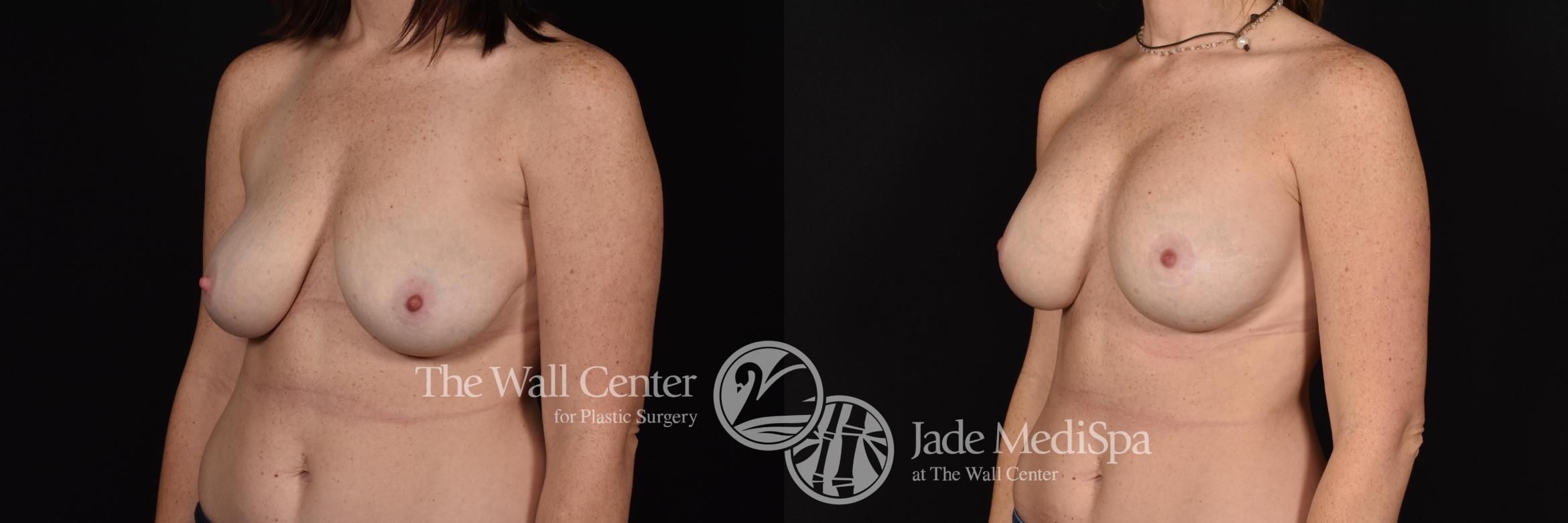 Before & After Breast Augmentation with Lift Case 584 View #2 View in Shreveport, LA