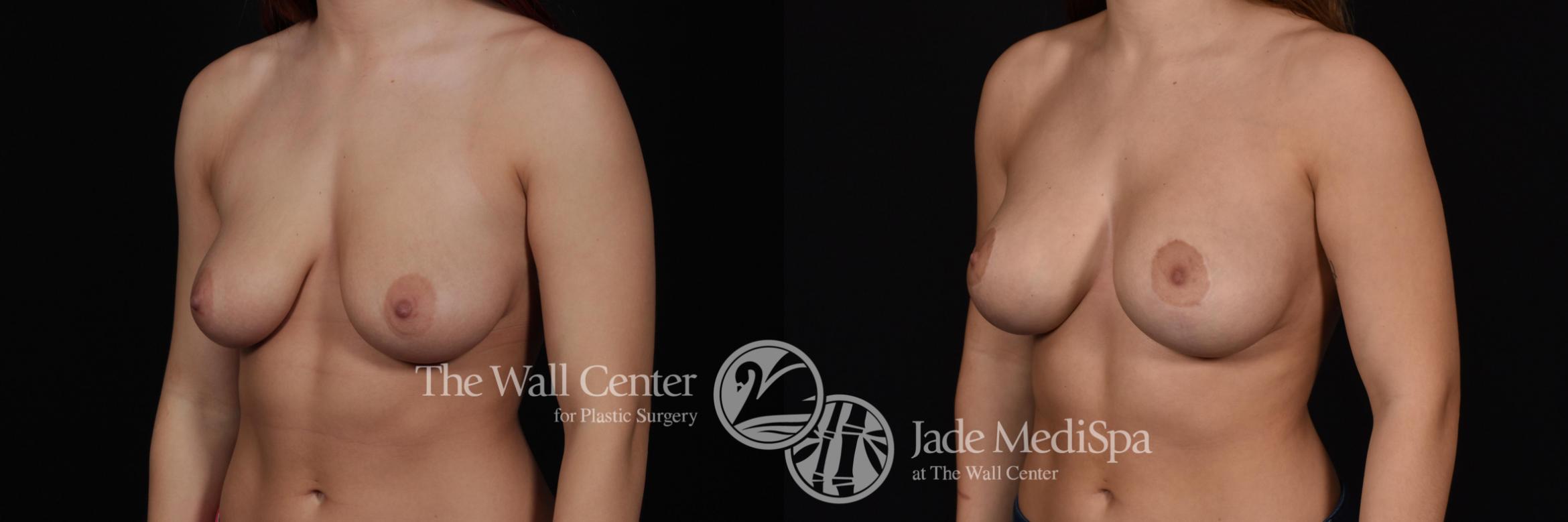 Before & After Breast Augmentation with Lift Case 587 View #2 View in Shreveport, LA