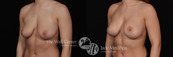 Before & After Breast Augmentation with Lift Case 587 View #2 View in Shreveport, LA