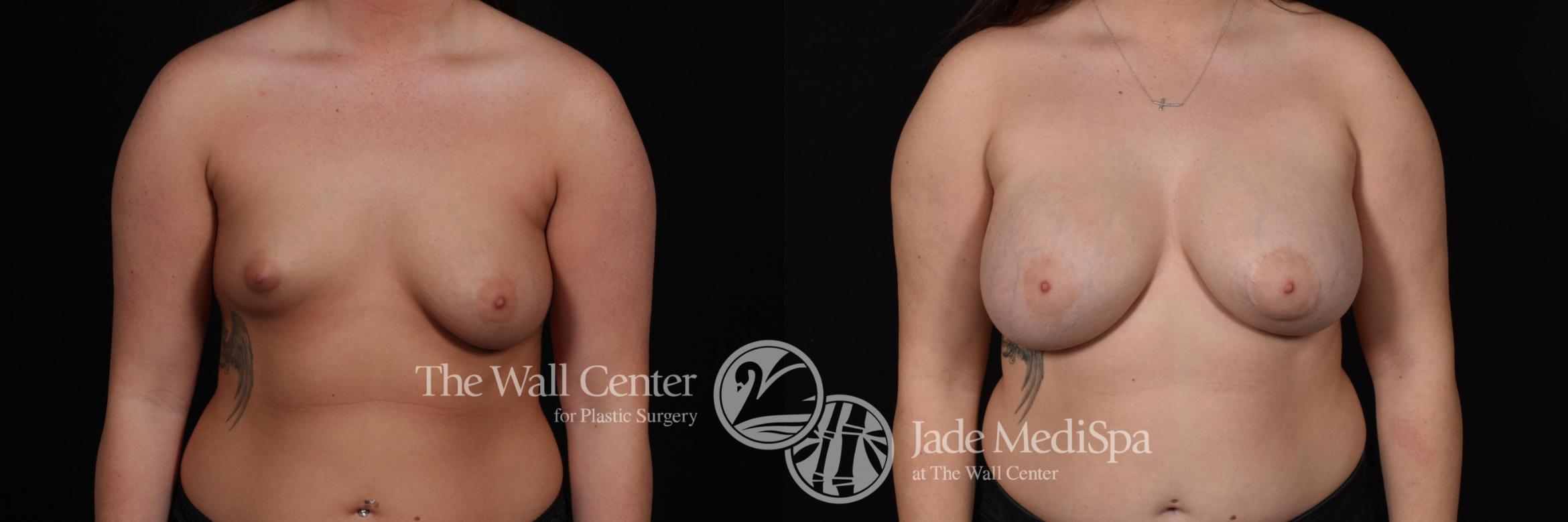 Before & After Breast Augmentation with Lift Case 588 View #1 View in Shreveport, LA