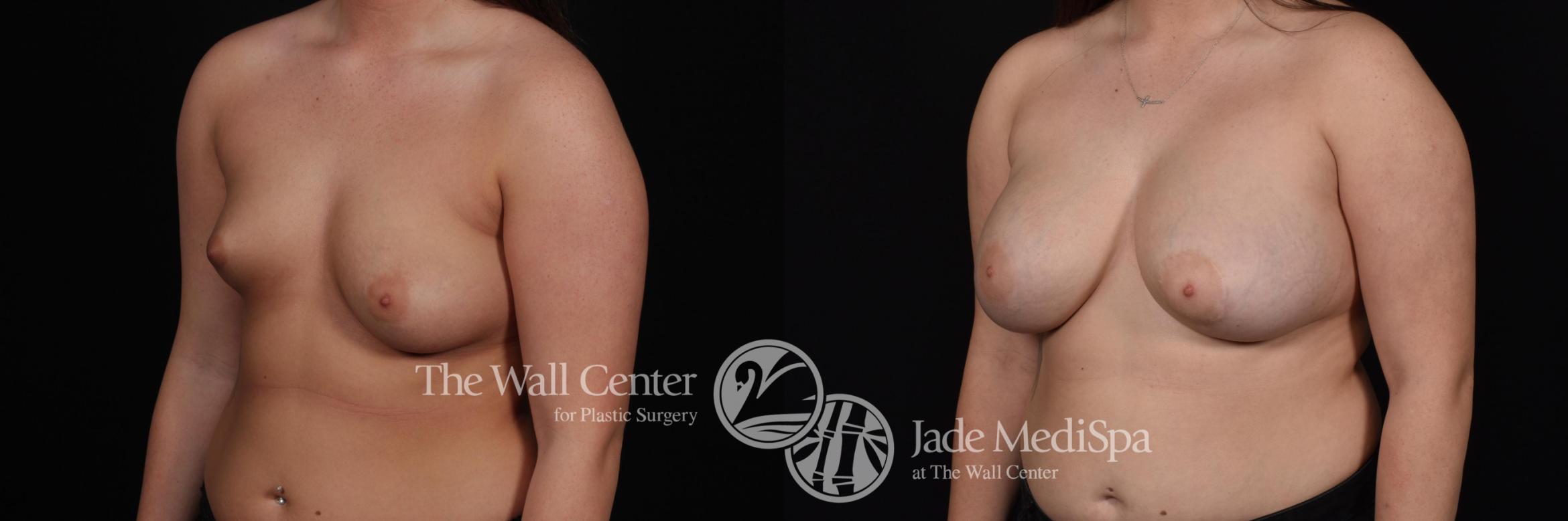 Before & After Breast Augmentation with Lift Case 588 View #2 View in Shreveport, LA
