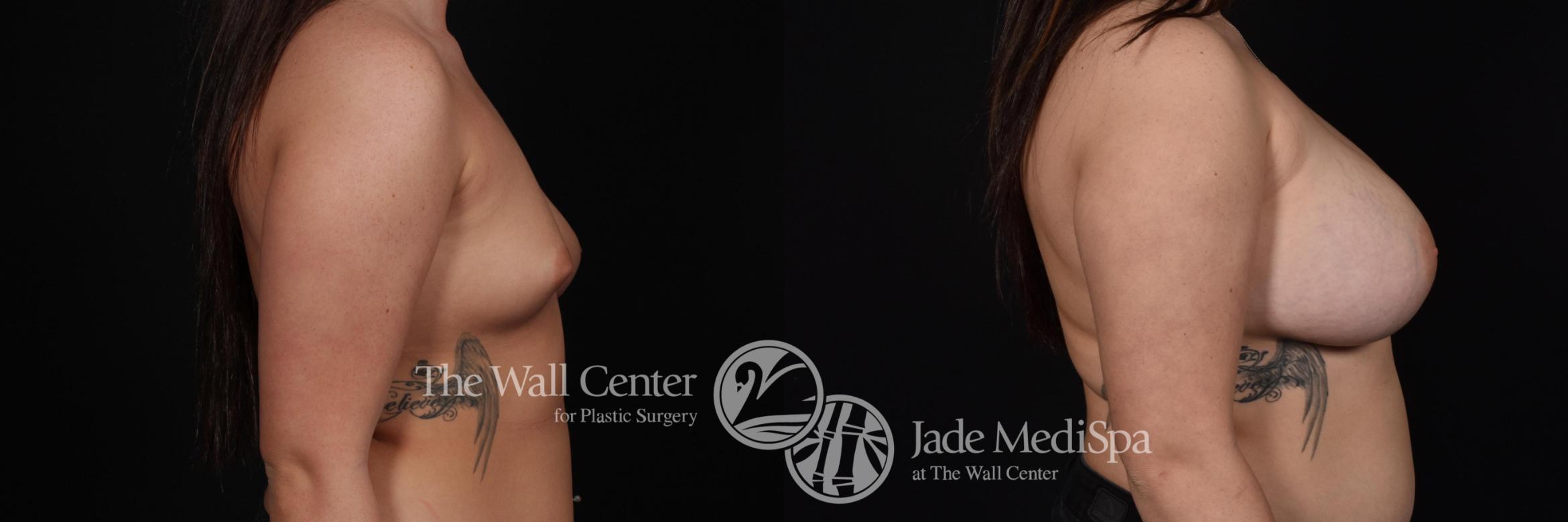Before & After Breast Augmentation with Lift Case 588 View #3 View in Shreveport, LA