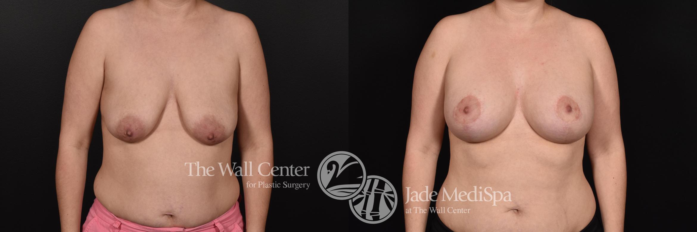 Before & After Breast Augmentation with Lift Case 594 View #1 View in Shreveport, LA