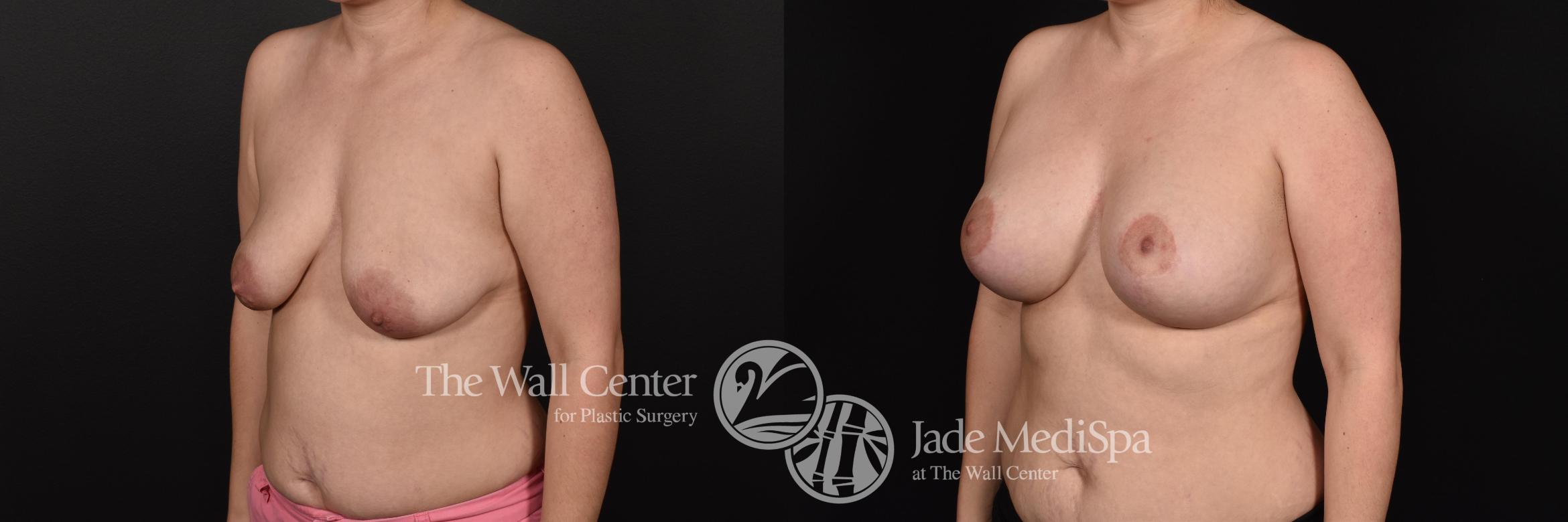 Before & After Breast Augmentation with Lift Case 594 View #2 View in Shreveport, LA