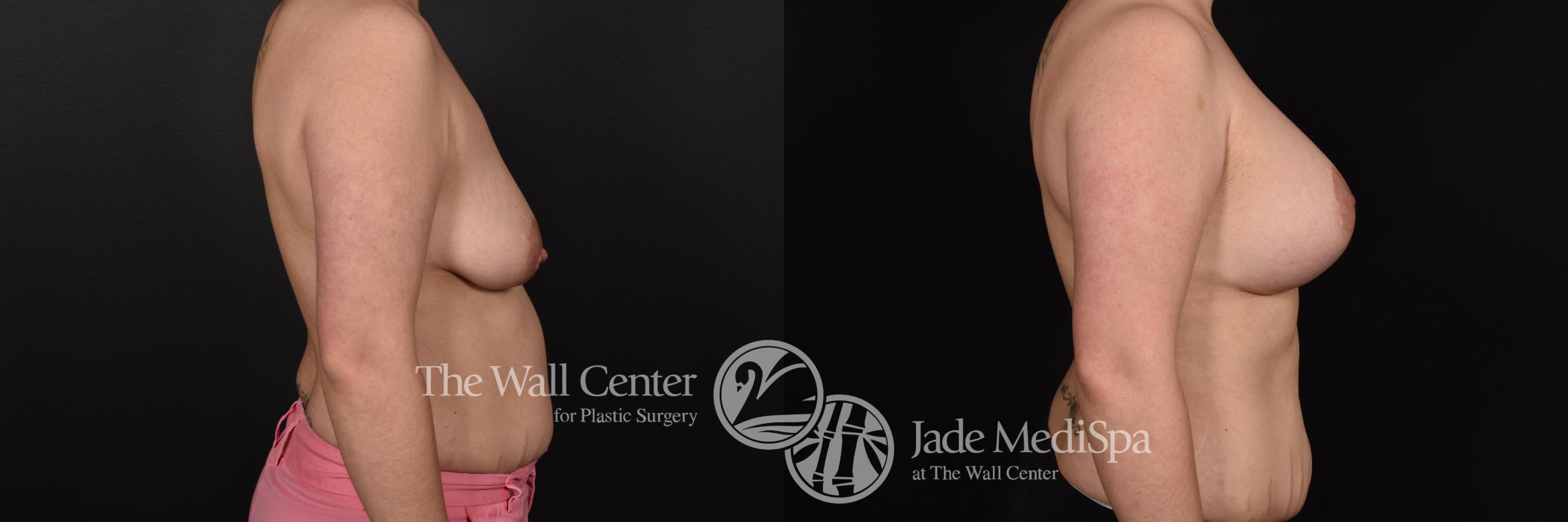 Before & After Breast Augmentation with Lift Case 594 View #3 View in Shreveport, LA