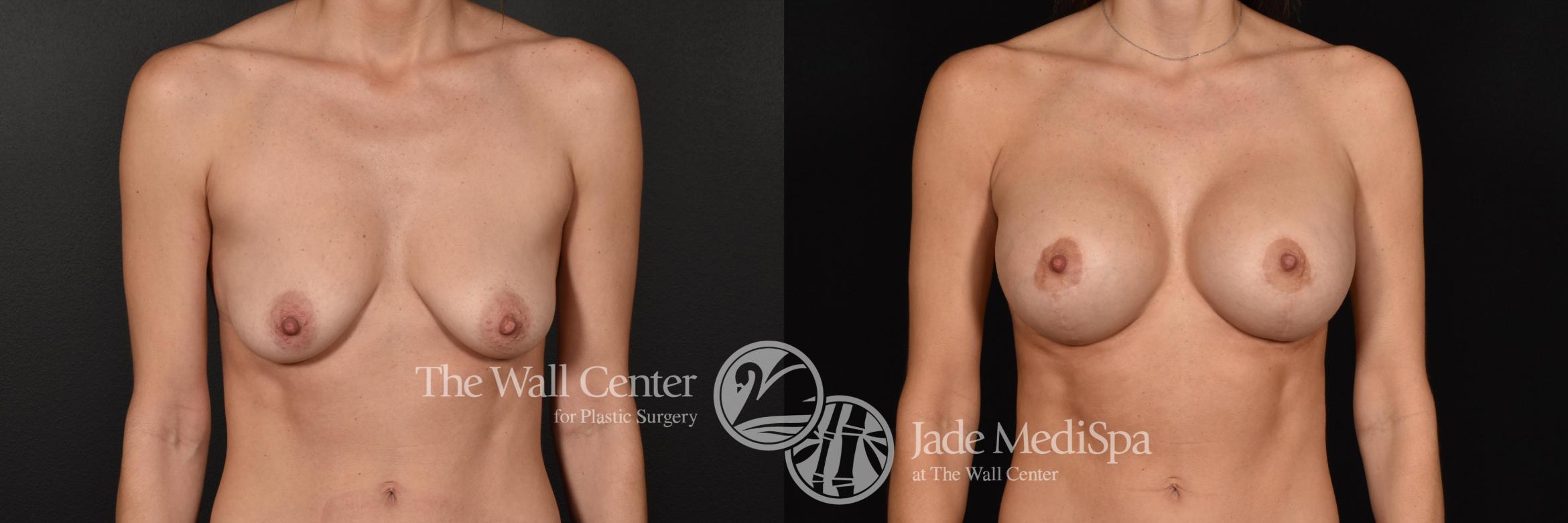 Before & After Breast Augmentation with Lift Case 603 View #1 View in Shreveport, LA