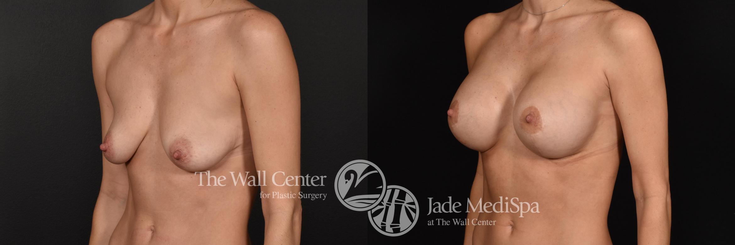 Before & After Breast Augmentation with Lift Case 603 View #2 View in Shreveport, LA